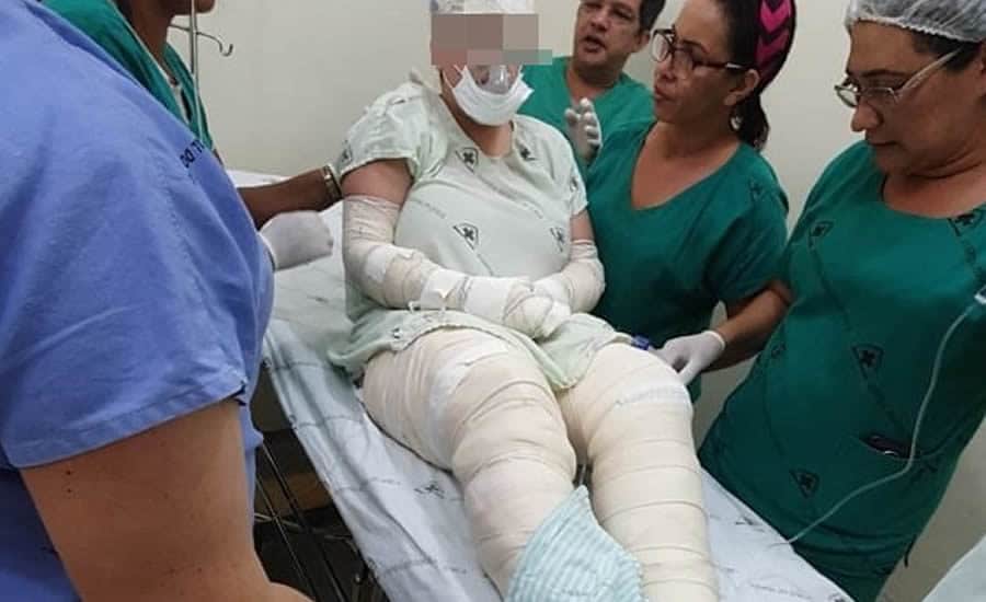 Adolescente com metade do corpo queimado ainda aguarda liberação da Gol para TFD