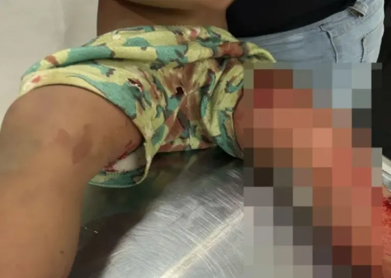 Criança de 7 anos é atacada por pitbull em município do Acre