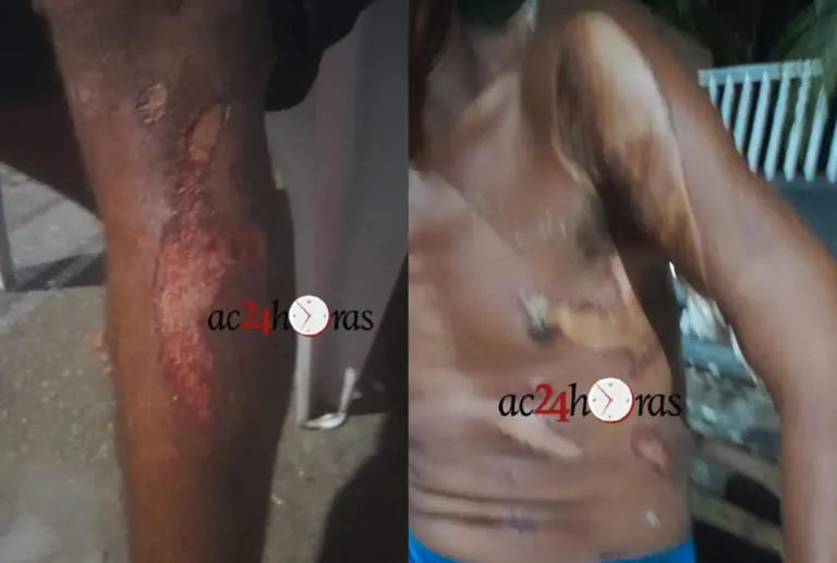 Morador de rua é queimado com ácido enquanto dormia em Rio Branco