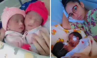 Gêmeas siamesas têm prognóstico negativo em Brasília e mãe quer UTI aérea para trazer bebês ao Acre