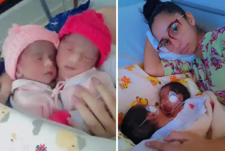 Gêmeas siamesas têm prognóstico negativo em Brasília e mãe quer UTI aérea para trazer bebês ao Acre
