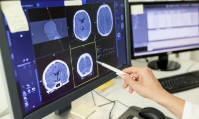 Covid-19 pode impactar o cérebro de forma semelhante à esquizofrenia, diz estudo