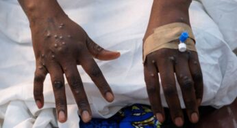 Brasil tem mais de mil casos de Mpox, segundo o Ministério da Saúde