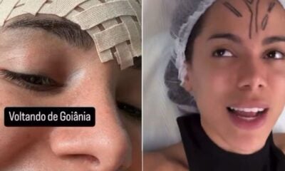 Anitta mostra curativo na testa e diz ter feito remoção de veia: ‘É só um laser’