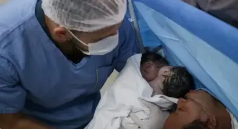 Gêmeas siamesas unidas pelo abdômen nascem em parto raro