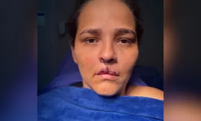 Acreana que teve lábio arrancado por cão faz primeira cirurgia reparadora