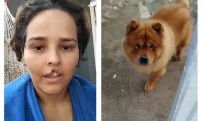 Acreana que teve lábio arrancado por cão fará cirurgia; cão foi sacrificado