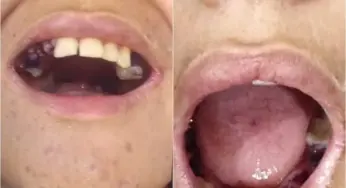 Adolescente com autismo tem 17 dentes extraídos por engano no Pará