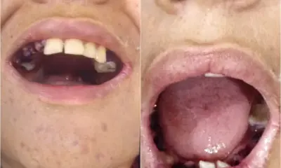 Adolescente com autismo tem 17 dentes extraídos por engano no Pará