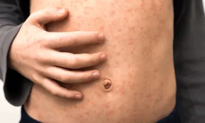 Nascidos entre 1991 e 2000 devem tomar reforço contra sarampo, diz infectologista