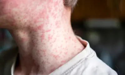 Veja suspeitas de sarampo por município no Acre; 17 notificações já foram descartadas