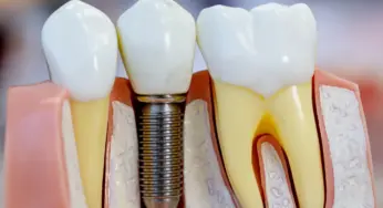 Instituto é responsabilizado pela morte de paciente voluntário em implante dentário