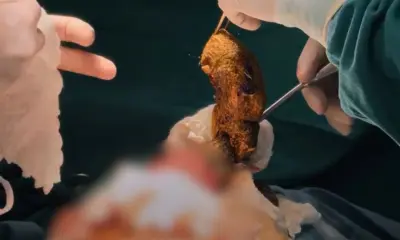 No Acre, criança faz cirurgia para retirar cabelo do estômago e intestino