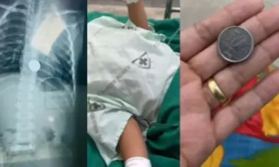 Criança de 5 anos engole moeda e passa por procedimento no Acre