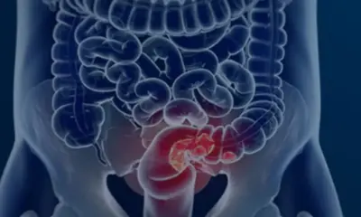 Estudo projeta aumento em mortes por câncer colorretal até 2040