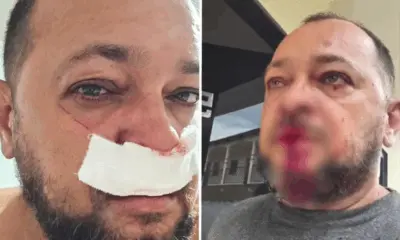 Motociclista é ferido por linha de pipa em Rio Branco: “quase me tira a vida”