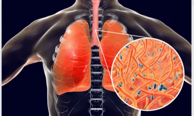 Acre mantém zero casos de coqueluche enquanto Brasil registra aumento
