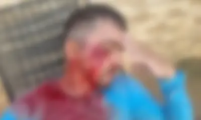 Gari é atacado com pedrada por não recolher vidro mal descartado no Acre