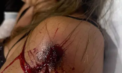 Mulher baleada em Porto Walter será transferida para Cruzeiro do Sul