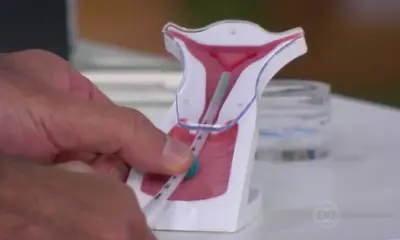 Acre passa a oferecer DIU e Implanon gratuitos para jovens de 14 a 19 anos