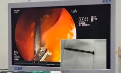 Prego é retirado do organismo de menino de 3 anos em Cruzeiro do Sul