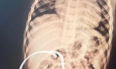 Menino de 3 anos está internado em Cruzeiro do Sul com prego alojado no intestino