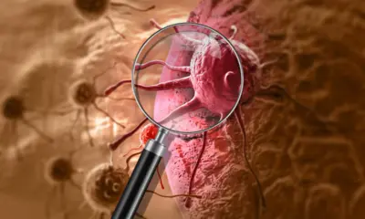 Acre deve registrar 1.170 novos casos de câncer em 2026, aponta estimativa do INCA