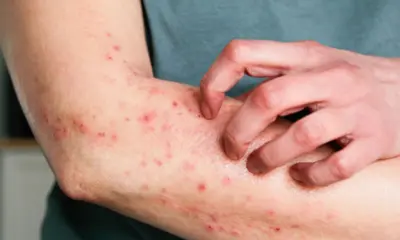 Caso suspeito de mpox em Rio Branco é descartado após exame negativo