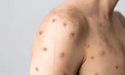 Rio Branco registra primeiro caso suspeito de Mpox e Vigilância acompanha