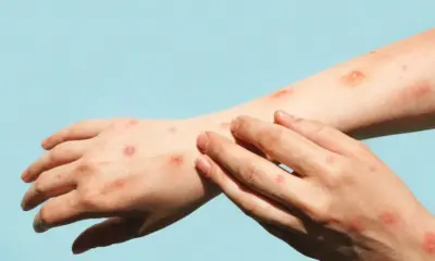 Rondônia contabiliza 4 casos de Mpox e Região Norte entra em monitoramento